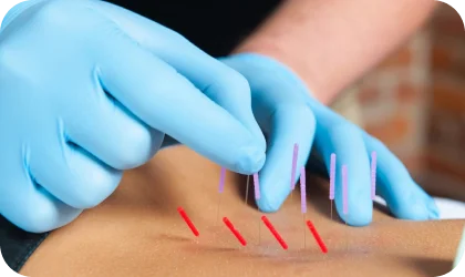 Dry needling
