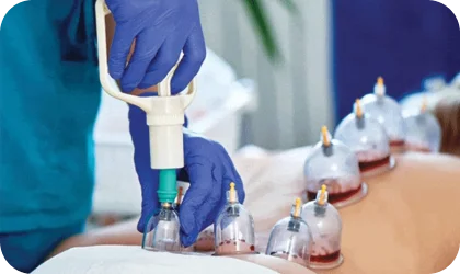 Hijama or Dry Cupping